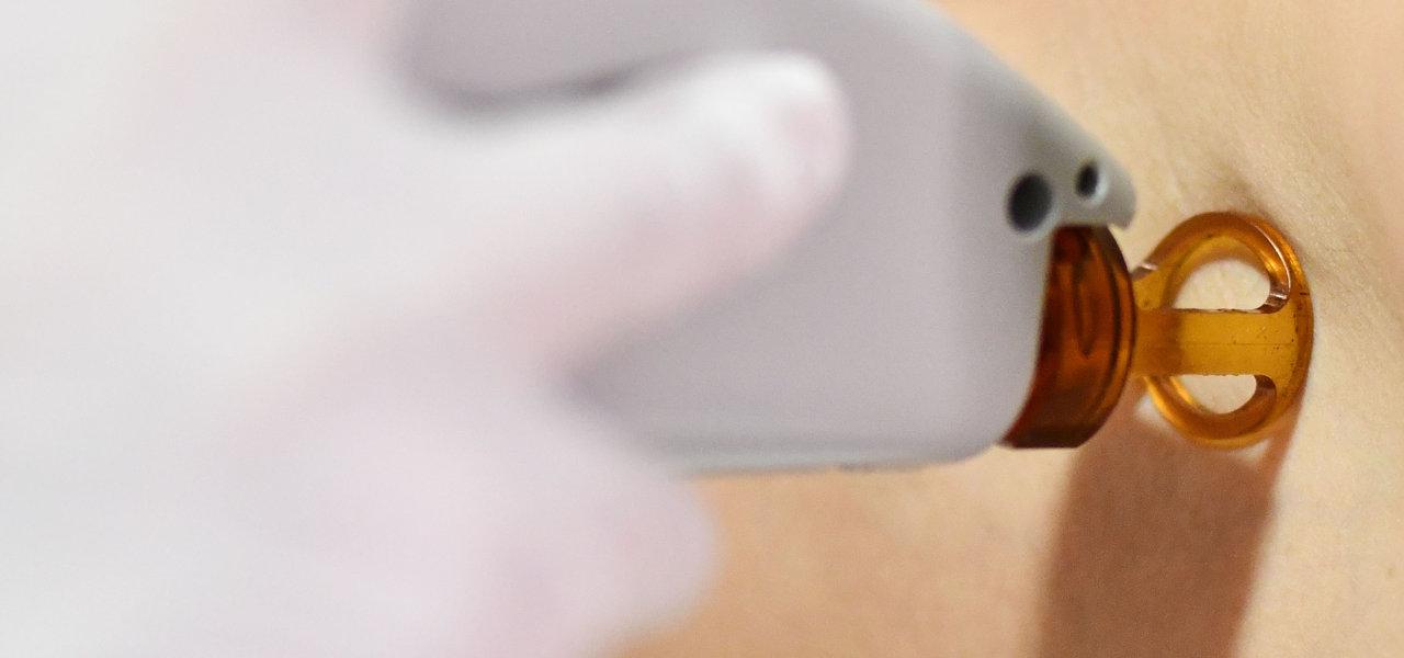 Depilaci�n laser - Foto